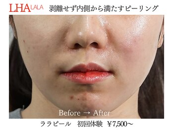 ビクトリー(VICTORY)/韓国肌管理ララピール