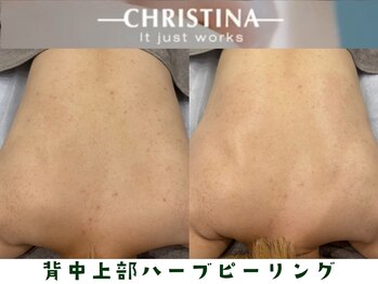 クレビア(CREBIA)/背中ニキビも効果的!