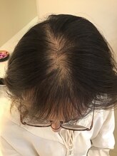 女性のための育毛促進・頭皮ケア専門サロン　イーズ／リバイタ　ららぽーと横浜/case1  20代女性　before