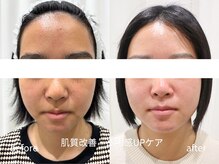 マイ フェア レディ(MY FAIR LADY)/毛穴・くすみ改善