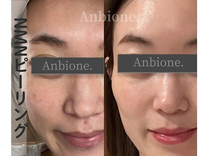 アンビワン(Anbione.)の写真