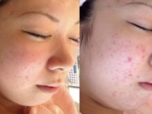 マビイ 都立大学(mavie)の雰囲気（ハーブピーリング「ニキビや毛穴、くすみに」）