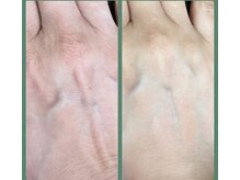 ブローディア(private estheticsalon Brodia)/生ヒト幹細胞培養液の実力