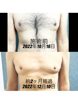アシヤ髭ラボ(ASHIYA 髭 LABO)/胸毛脱毛ビフォーアフター