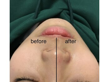 ココ(coco)/毛穴の黒ずみ撃退☆