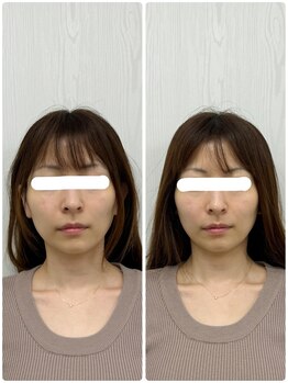 ラフテル鍼灸整骨院/小顔整体で顎、頬の歪み改善♪