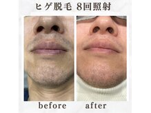 ボゴス 天白店(BOGOSS)/【ヒゲ脱毛】施術写真
