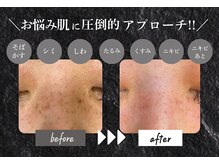 冬だからこそシミケア！あらゆるお悩みにお応えいたします！