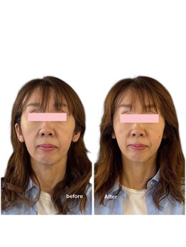 ニコディア(nico-dia)/美容鍼