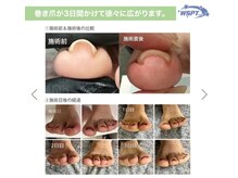 エヌエープラスネイル 葛西本店(Na+nail)/巻き爪ケア