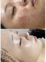 クレヴィー(Creviy)/なかなか改善されない肌荒れも