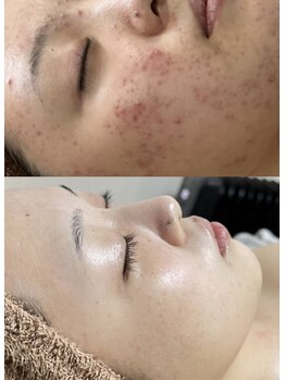 クレヴィー(Creviy)/なかなか改善されない肌荒れも