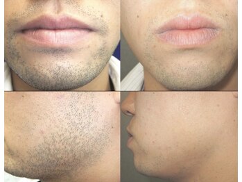 ブブオム 恵比寿本店(BUB OMME)の写真/【脱毛効果UP!】毛穴洗浄×お顔のお好きな部位脱毛(鼻下/顎/口周りのヒゲをお得にメンテナンス)[恵比寿]