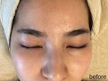 サロン ド エメ(salon de aimer)/【Before】ざらつき、毛穴に!