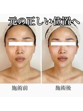 エデルビューティー(ederux beauty)/小顔コルギ！正しい位置へ戻す