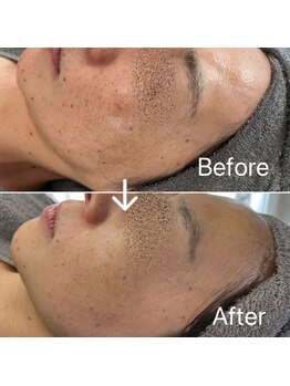 ブルームーン(Blue Moon)/ララピール 施術4回