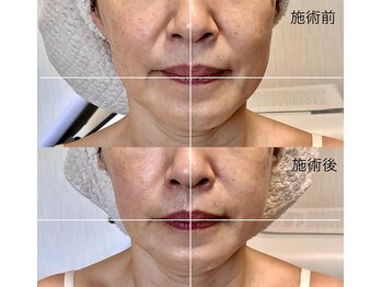 カルナ(CARNA)/エラ張り・お顔の左右差改善