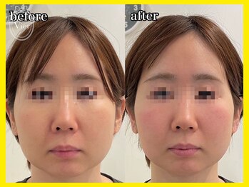 ヴィオール 名古屋栄店(VIOR)/1回でスッキリ! 脂肪撃退!