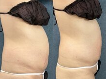 ビーホープ(B.hope)/30代モニター様２回目