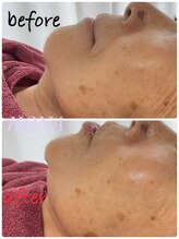 ホナ(HONA)/法令線が一回でこんなにちがう！