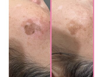 ラヴィエール(Laviere)/しみ緩和