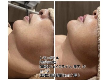 フォルチェ 神辺店(Folche)/小顔は永遠に人気！￥8800