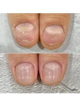 リファーレ(RIFARE)/【深爪矯正】凸凹爪も変わる！