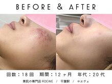 ロエヴェ(ROEWE)/ニキビ改善・毛穴ケア・肌質改善
