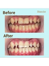 ホワイトニングサロン Blanche 心斎橋店/ビフォーアフター