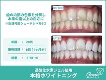 クレア(Crea)/【ホワイトニング症例写真】