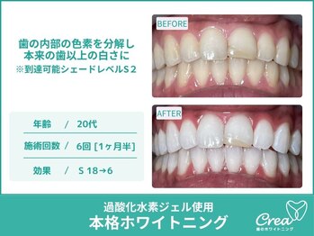 クレア(Crea)/【ホワイトニング症例写真】