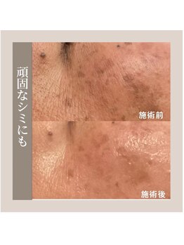 ルシアル(LUCIALL)の写真/【気になるシミに!】年齢肌のお悩みに寄り添う肌質ケアを◎大人女性のための、シミケア施術を♪
