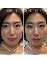 サス(SASU)/圧倒的な小顔！継続で豆小顔！！