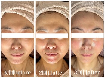 ルー ハナレ 神戸岡本 摂津本山店(Luu HANARE)/くすみ改善　目元凹みケア