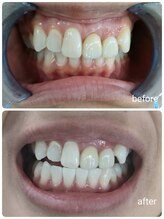 エクシアホワイトニング 碧南店/ホワイトニングビフォーアフター