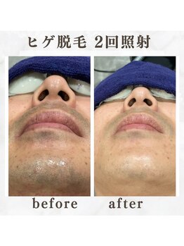 ボゴス 天白店(BOGOSS)/【ヒゲ脱毛】施術写真