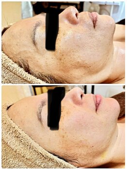 サロン ド ビューティー ラ デュース/シミケアモニター様