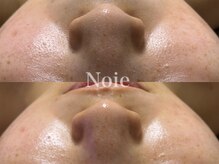 ノイエ(NOIE)/ハーブピーリング肌質改善　Noie