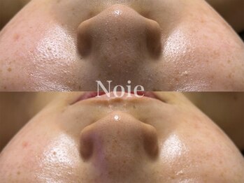 ノイエ(NOIE)/ハーブピーリング肌質改善 Noie