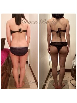 グレイスボディ BiViつくば店(Grace Body)/◆痩身　症例写真