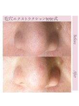 サロン サルタス(salon Saltus)/毛穴エクストラクション