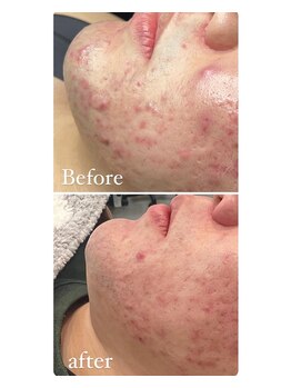 ロザブルー(ROSA BLU)/Before/after