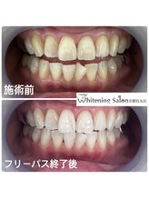 ホワイトニングサロン 京都烏丸店/ホワイトニング施術例