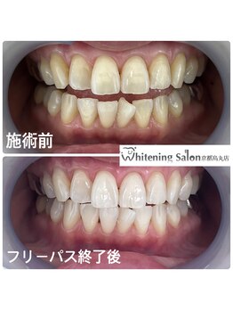 ホワイトニングサロン 京都烏丸店/ホワイトニング施術例