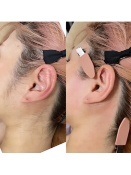 ミーミドットアイ(Mi-mi.i)/うなじワックス脱毛