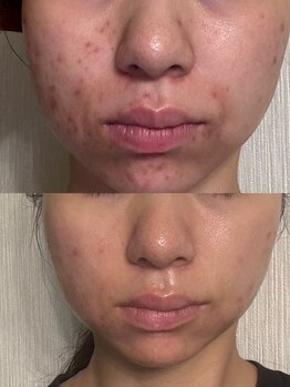 ユウビ ビューティー サロン(Yuubi)/【peel stage】ハーブピーリング