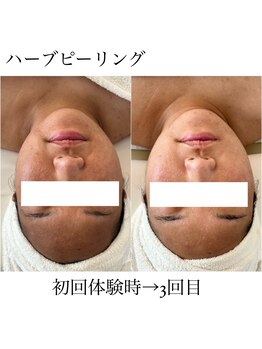 イム(I'm.)/ハーブピーリング before/after