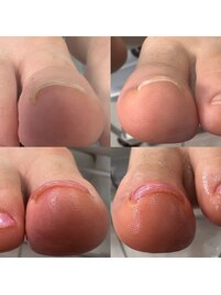 巻き爪ケア＋ジェルネイル