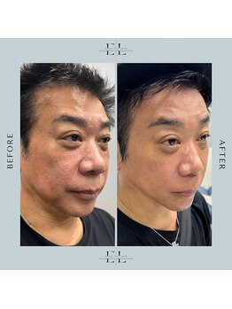 モア(eyelash salon MOOR)の写真/【凸凹肌/赤味/ニキビ改善の最高峰コース】プラズマ＋ハーブ(剥離なし)＋鎮静パックで長年お悩みの方にも☆