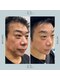 モア(eyelash salon MOOR)の写真/【凸凹肌/赤味/ニキビ改善の最高峰コース】プラズマ＋ハーブ(剥離なし)＋鎮静パックで長年お悩みの方にも☆